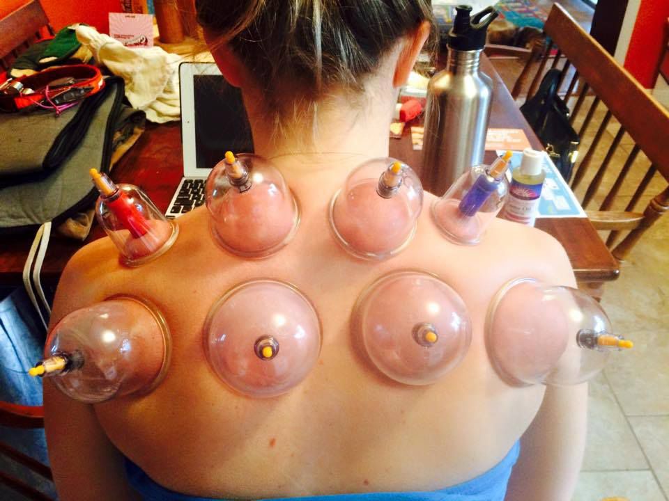 cupping for breast health